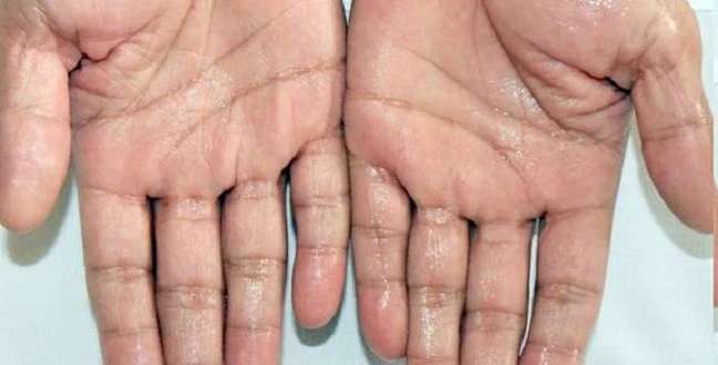  Aşırı El Terlemesinin Tedavisi Mümkün